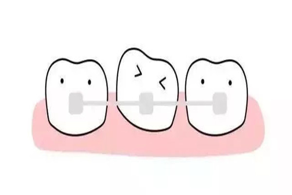 牙齿矫正可以改善脸型吗 牙齿矫正可以改善下巴后缩吗