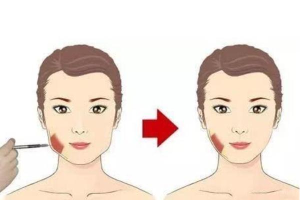 瘦脸针的危害有什么副作用 瘦脸针越打越老