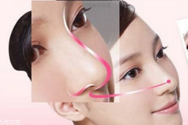 硅胶隆鼻可以取出来吗 硅胶隆鼻取出后有哪些症状
